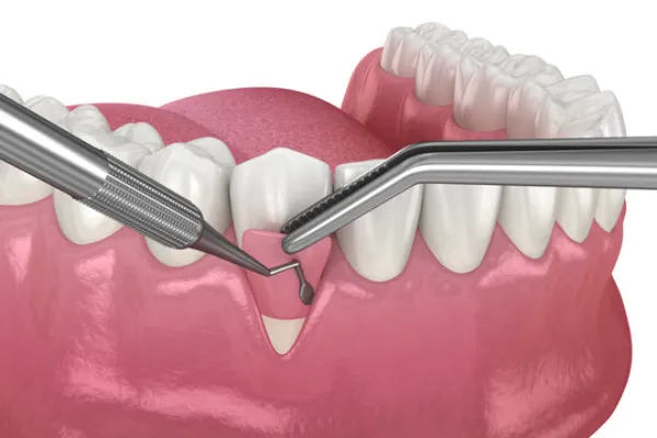 Periodontal Flap Surgery