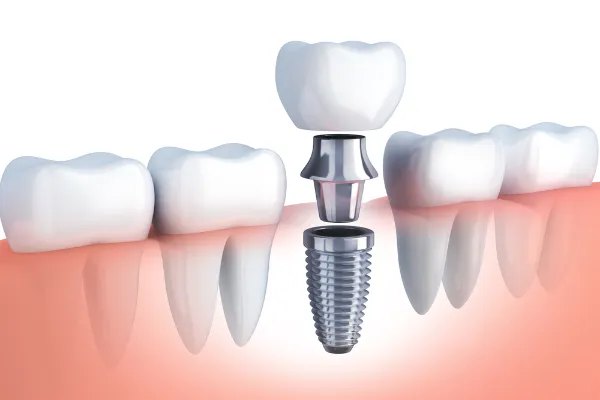 Dental implant for missing tooth
