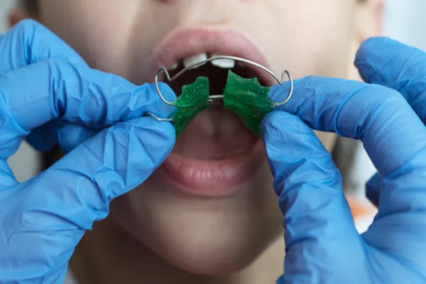 occlusal bite adjustment in wayne nj dr. fine fine dental care