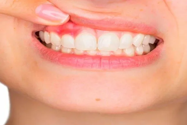 Gingivitis Treatment