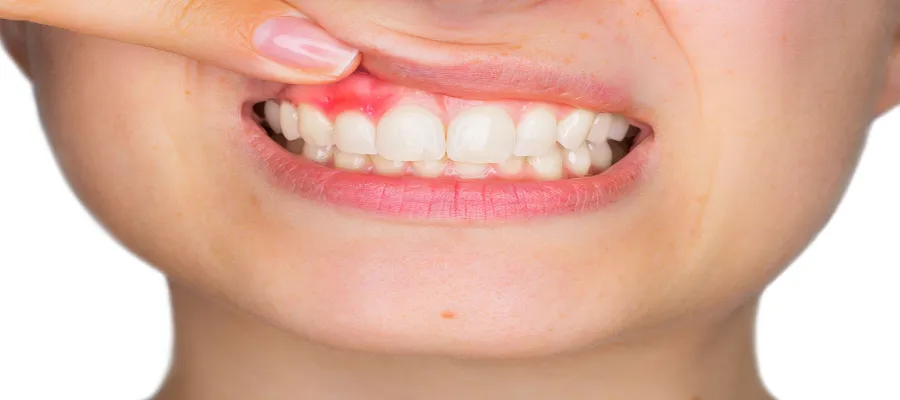 Gum Treatment