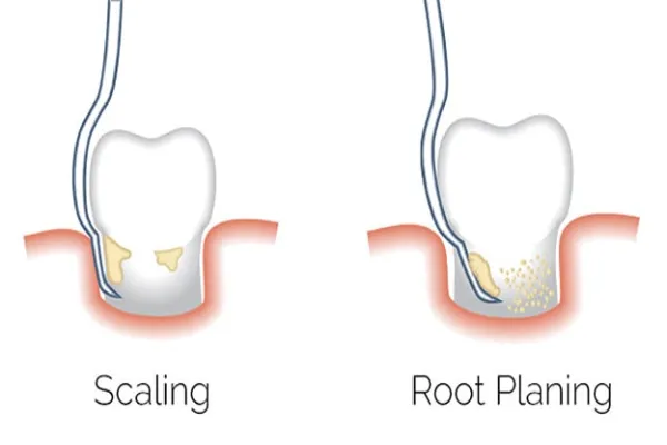 Scaling & Root Planing