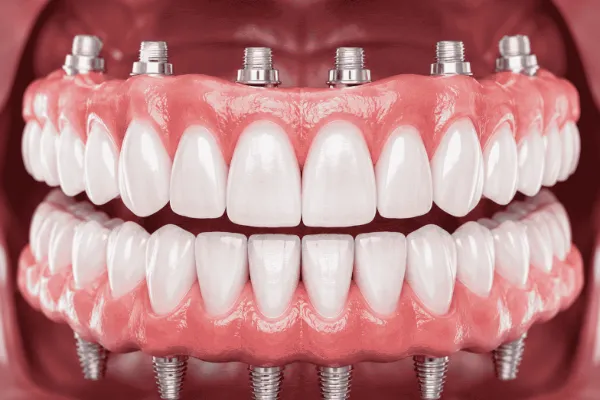 full mouth rehabilation