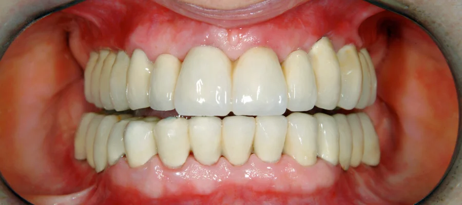 full mouth