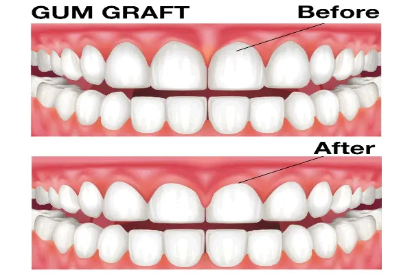 gum graft (1)