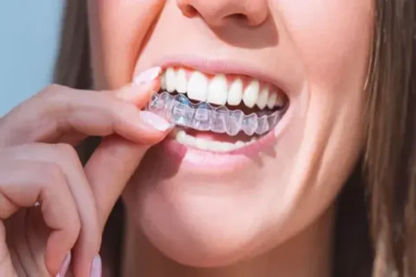 Clear Aligners (Invisible Braces)