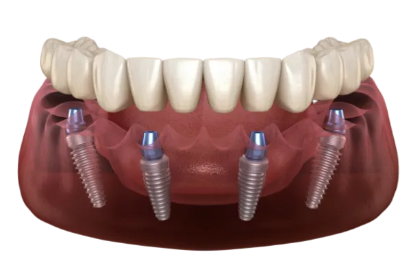 All-on-4 Dental Implants