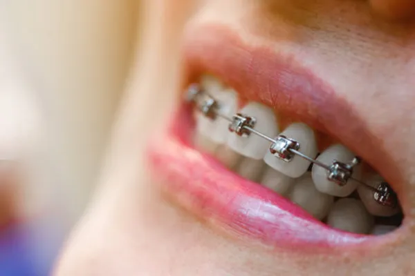 Self-Ligating Braces