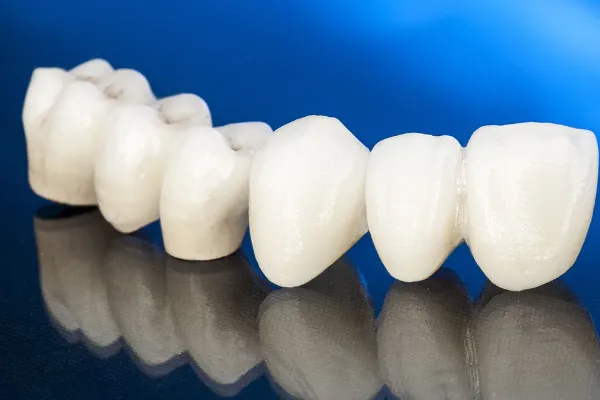 Dental Crowns & Bridges for Restoring Teeth