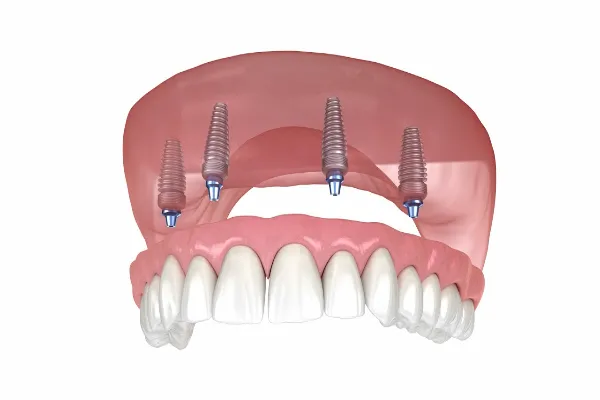 Implant-Supported Dentures