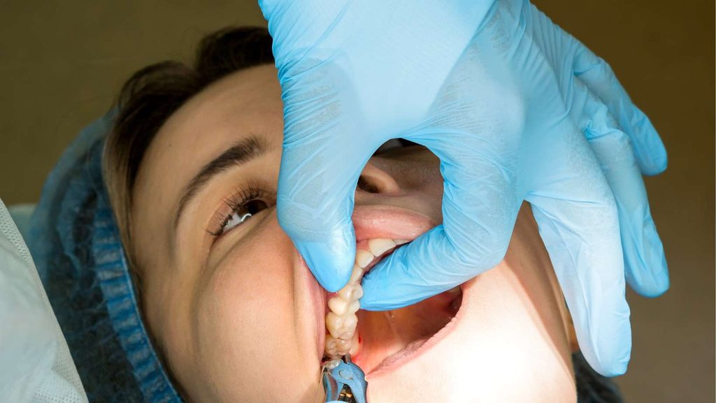 Wisdom Tooth