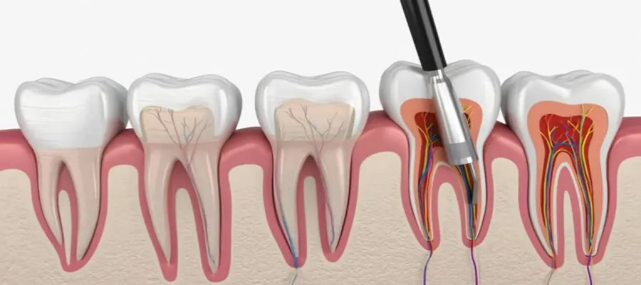 Root Canal Treatment in Pune