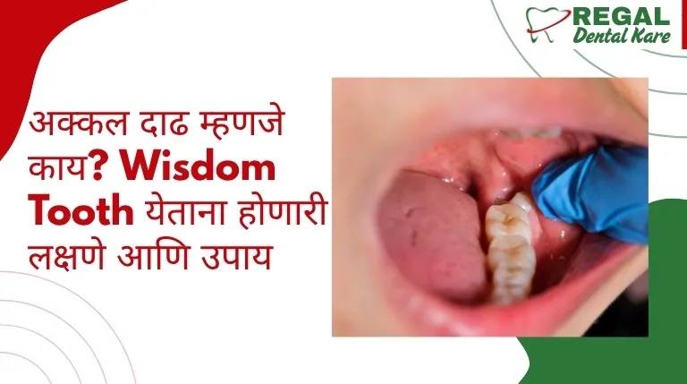 Wisdom Tooth