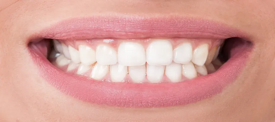 Teeth Whitening