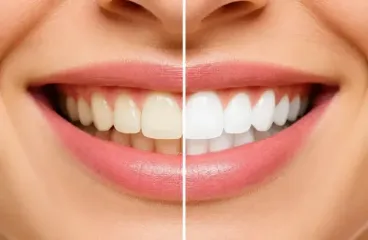 teeth whitening