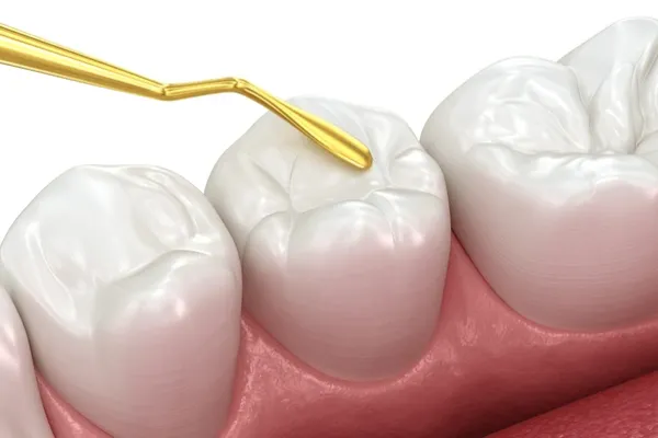 Dental Filling Treatment